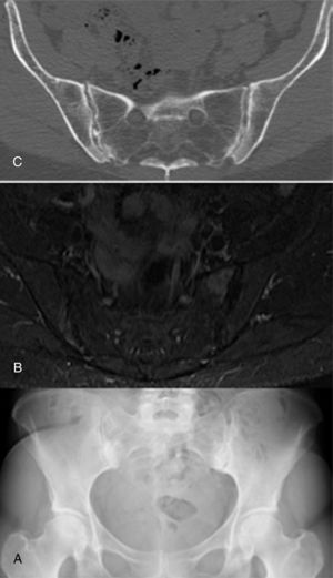 (A) Anteroposterior radiograph of pelvis showing calcification in fibrocartilage in the pubic symphysis, as well as sclerosis in both sacroiliac joints with cortical irregularity. (B) Axial slice of magnetic resonance of the pelvis. Short-tau inversion recovery (STIR) sequence, with hyperintense signal in both sacroiliac joints. (C) Computed tomography, axial image, of pelvis, showing the vacuum phenomenon in right sacroiliac joint, as well as calcification in fibrocartilage of both sacroiliac joints, with osteophytes.
