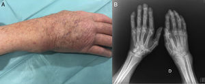 (A) Image of the patient's right wrist. Soft tissue mass located in the region of ulna that responded to pressure and was mobile. (B) Plain bilateral radiographs of the hands. Generalized osteopenia, reduction of the joint space in right wrist. Thickening of soft tissue most evident in the region of the ulnar styloid. Severe distortion of the architecture of the radiocarpal joint and ulnocarpal fossa.