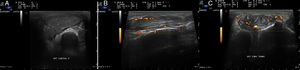 (A) Image of the dorsal compartment of right wrist. Distortion of the architecture of the extensor compartments. Presence of a large soft tissue mass that deforms the border of the common extensors, the extensor of the fifth finger and the extensor of the ulna. (B) Longitudinal view, and (C) transverse view of the common extensor tendon of the fingers at the level of the wrist. Increase in neovascularization with evident color Doppler signal (G3) showing activity over the extensor tendon and infiltration of surrounding infectious material.