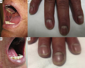 (A) and (B) The presence of hyperpigmented spots on the mucosa of the inner lining of the cheeks and lower lip, with well-defined borders. (C) Presence of brown-colored hyperpigmented bands in the area of the fingernails. (D) Decrease in the intensity of the pigmentation in the area of the fingernails (although it did not completely disappear) 3 years after discontinuing chloroquine.