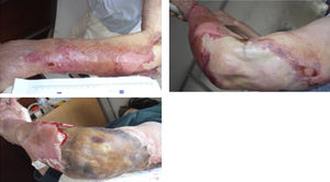 Evolution of skin lesions at first five days of internment: áreas of extensive skin detachment in the context of ruptura of blisters and severe exudation and necrotic áreas.