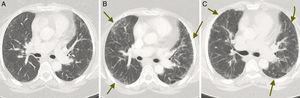 Serial computed tomography scans taken in the axial plane: (A) initial phase, (B) high point of the process and (C) resolution. The figure shows small bilateral patchy ground-glass opacities, predominantly in the periphery, as a key finding (arrows), and a slight thickening of the interstitium between lobes.