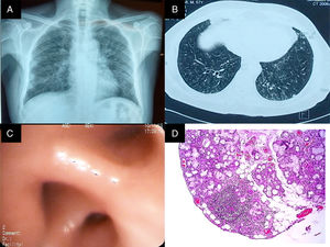 (A) Posterior–anterior chest radiograph. Images compatible with bilateral reticulonodular pattern, predominantly basal, with conserved lung size. (B) High-resolution computed tomography of the chest with images of the signet ring in both lungs, centrilobular nodules and budding tree pattern. (C) Bronchus of the right lower lobe with edema and concentric narrowing of the orifices of the lung base. (D) Biopsy of the salivary gland. Predominantly lymphocytic inflammatory infiltrate, with the formation of 2 lymphoid aggregates of more than 50cells/mm2.