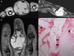 (A–C) Magnetic resonance images; multilobulated expansile lesion, with endosteal scalloping and substantial cortical thinning, which is hypointense in T1 (axial plane) and hyperintense in the T2-weighted sequence with fat suppression (sagittal plane) and in a short tau inversion recovery (STIR) sequence (coronal plane). (D) Biopsy of the tumor showing mature hyaline cartilage (arrows), with areas of myxoid degeneration (arrowheads), compatible with enchondroma.