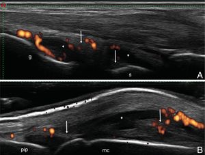 (A) Carpus. Dorsal longitudinal plane. Capsular distension in the radiocarpal and intercarpal joints recesses, both with synovial fluid (*) and areas of synovial proliferation (arrow), with increased vascularization by power Doppler (grade 2). (B) Metacarpophalangeal joint. Dorsal longitudinal plane. Joint capsular distension with areas of synovial fluid (*) and areas of synovial proliferation (arrow), with increased vascularization by power Doppler (grade 2). l, large; mc, metacarpophalangeal joint; pip, proximal interphalangeal joint; r, radiocarpal; s, semilunar.