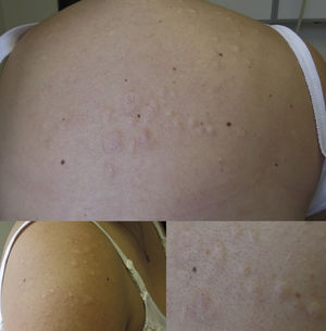 Skin-colored papules and plaques on the patient's back and right shoulder, where the skin appears to be lax.