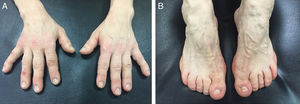(A and B) Diffuse thickening of soft tissue and acral enlargement of both hands and feet.