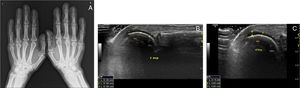 (A) PA conventional X-ray of hands showing diffuse soft tissue hypertrophy, acral enlargement and joint space widening. (B and C) Ultrasound longitudinal image of the second and fourth MCP joints in maximal flexion shows increased anechogenic cartilage thickness (normal 0.02–0.05cm).2 Mcp, metacarpophalangeal joints; mc, metacarpal head; P, proximal phalanx base; T, extensor tendon; * cartilage.