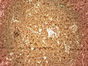 Biopsy of low grade B-cell lymphoma of MALT type of the parotid gland. CD 20 stain showing sheets of B cells in case 2.