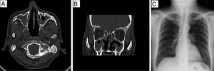 (A and B) Computed tomography images of paranasal sinuses in simple phase: axial scan (A), coronal scan (B), swollen nasal mucosa, slight bone erosion involving left maxillary antral wall (red arrow) and inferior turbinates. (C) Normal posteroanterior chest radiograph; no lesions on lung parenchyma.