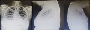A 22-year-old woman with a 3-year history of generalized lupus erythematosus characterized by skin and musculoskeletal manifestations. She presented with a 1-month history characterized by pleuritic-like pain and dyspnea. Plain chest radiography revealed radiopaque images that obliterated the costophrenic angles, compatible with pleural effusion. It was contended with and was subsequently attributed to the activity of her underlying disease.