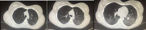 A 24-year-old woman with a 4-year history of generalized lupus erythematosus characterized predominantly by musculoskeletal and hematological manifestations (autoimmune hemolytic anemia). She came to the emergency department with a 10-day history consisting of dyspnea and dry cough and later on with hemoptysis on 6 occasions. At admission, she had tachycardia and hypoxemia. Computed tomography revealed predominantly bibasal ground glass. After an infectious process was ruled out, the possibility of lupus pneumonitis was considered. She received pulses of methylprednisolone and cyclophosphamide and improvement was achieved.