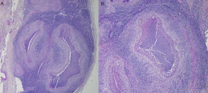 Biopsy: (A) Lymph node displaced by large granulomas with a stellar form (hematoxylin–eosin, 2×). (B) Micro-abscessed with pyocytes, surrounded by a palisade of histiocytes encircled by small lymphocytes (hematoxylin–eosin, 4×).