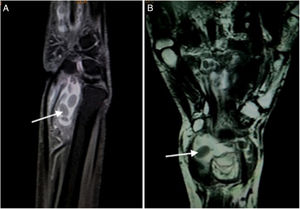 (A) T2W FAT SAT sagittal image show a well defined fluid intensity collection seen along the flexor tendon sheath with presence of hypointense layered rice grain (white arrow) shaped within it suggestive of tenosynovitis with multiple loose bodies. (B) T2W Coronal images show well defined fluid intensity collection anterior to the wrist joint along the flexor tendon sheath suggestive of tenosynovitis. Multiple layered hypointense loose bodies like rice grain are seen within it (arrow).