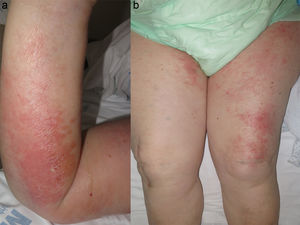 (a) Erythematous and edematous plaque with superficial vasiculobullae in right upper limb. (b) Edema and erythematous and edematous plaques on thighs.