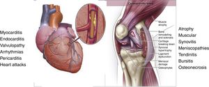 The joint is like an organ. The knee joint is constituted by the subchondral bone, the joint cartilage, the synovial membrane, the cruciate ligaments, meniscuses, the joint capsule, periarticular ligaments, bursae and skeletal muscle that surrounds them. All of these specialized tissues are organized in such a way that collectively they are capable of fulfilling a function: joint mobility. Damage to these tissues can lead to the development of osteoarthritis and the dysfunction of the organ.