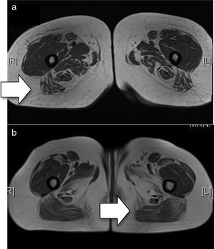 (a) Baseline MRI (T1 sequence). There is minimal oedema in the distal end of both the sartorius and gracilis muscles. Compromise of both compartments, with the lateral mass more affected in the anterior compartment and the middle masses more affected in the posterior compartment. In general, there is greater posterior compromise (arrow). (b) MRI after treatment with rituximab (T1 sequence). Bilateral and symmetrical compromise is noted of both compartments with muscular atrophy observed with diffuse fatty deposits. The lateral and middle masses are more affected in the anterior compartment and the hamstring muscles are more affected in the posterior compartment, with predominance of compromise in the posterior compartment (arrow).