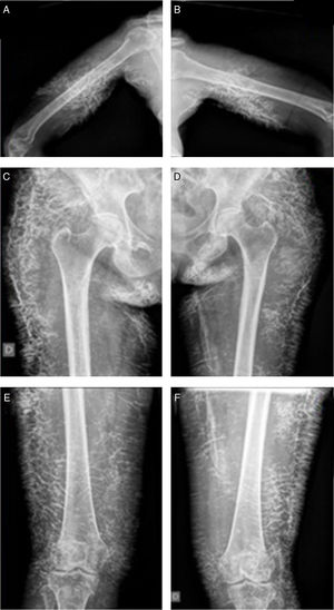 Extensive lineal calcifications of reticular appearance in dermis and hypodermis: (A, B) upper limbs; (C–F) lower limbs.