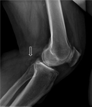 Lateral X-ray of the knee: exophytic bone lesion (arrow) tibia-dependent corresponding to an epiphyseal osteochondroma.