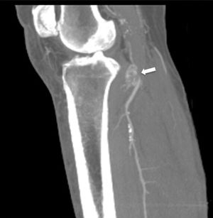 CT angiogram. Sagittal slice. Maximum intensity projection (MIP). Thrombosis of the popliteal artery (arrow) with distal rechanneling.