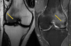 Magnetic resonance: (A) Image at 2nd month. Right knee, involvement of external condyle. (B) Image at 6th month. Right knee, involvement of internal condyle.