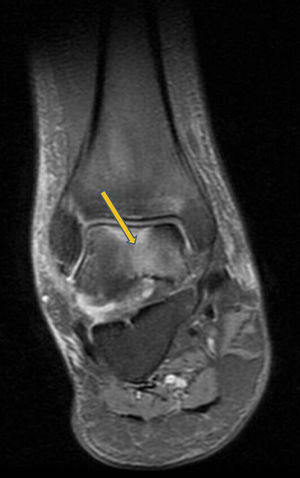 Magnetic resonance at 7th month. Right ankle. Involvement of the astragalus.