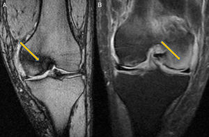 Magnetic resonance imaging: (A) Situation at 10th month. Left knee. Involvement of the internal condyle. (B) Situation at 12th month. Left knee. Involvement of external condyle.