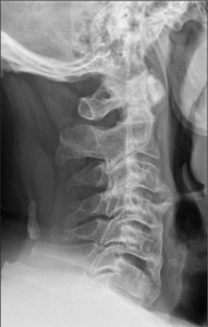 Cervical spine X-ray: the height of the vertebral bodies are preserved. Calcification projected onto the soft tissues in the dorsal section in the occipito-vertebral ligament.
