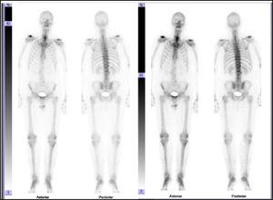 Bone scan with normal pattern of uptake on the cervico dorsal skeleton and discrete uptake on the right-hand side of the lumbar rachis.