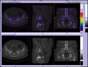 SPECT/CT slice images in axial, sagittal and coronal planes with low uptake of the radiopharmaceutical in sacroiliac joints. Sacroiliac/promontory values below cut-off level established for diagnosis of sacroiliitis.7,8