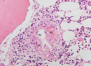 Microphotography of bone marrow (H&E, ×400). Epithelioid granuloma (a) of an angiocentric disposition (b) shows the small blood vessel with areas of necrosis and fibrinoid degeneration (c).