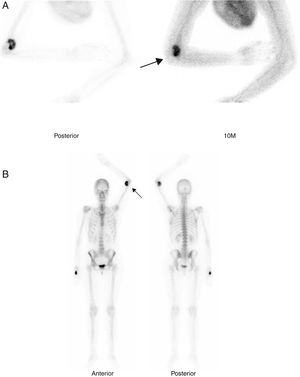 Two phase bone scan after the injection of 814MBq of 99mTc-hydroxy-biphosphonate. Static images after 10min (tissue phase [A]) and total body after 2h (bone phase [B]), where heterogeneous uptake may be observed of the radiotracer in anterior region of the left elbow (arrows).