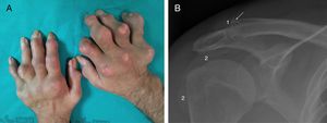 (A) Hands with multiple tophi. (1) Simple X-ray of right shoulder in anteroposterior projection. In the clavicle region of the right acromioclavicular joint a punched-out eccentric bony erosion is observed, formed by the replacement of the bone by a less dense tophus (1). Due to the slow, benign growth the bone reacts forming a sclerotic “ring” which surrounds the tophus and even overlaps the anatomical limits of the bone forming a raised edge (→). The change in the glenohumeral joint is mainly apparent in plain X-ray due to the occupation of the subacromiodeltoid bursa (2).