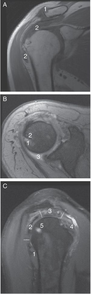 (A) MR image of the right shoulder in coronal plane in T1 weighted sequence. In one image superimposed onto the X-ray of Fig. 1B we may observe the tophi as hypointense soft tissue masses in T1 along the upper ridge of the distal end of the clavicle (1) and in the subacromiodeltoid bursa (2). (B) Image in axial T2 gradient-echo plane. The MR reveals a lesion compatible with gouty tophus (1) in the glenohumeral joint edge which is not clearly visible in plain X-ray. It is hyperintense in T2 weighted sequence, interrupts the bony cortex and has a highly hypointense ridge from bone sclerosis (2). Mild synovial effusion is present (3). (C) Proton density image in sagittal plane which enables vision of the section of the tendon which forms in the sleeve of the rotator cuffs: teres menor (1), infraespinatus (2), supraespinatus (3) and subescapularis (4). The supraspinatus is particularly de-structured by the presence of a nodule suggestive of intratendinous tophus (*). Similarly to the T2 weighted sequence, the bony tophus is hyperintense (5).