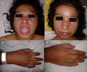 (A) Macroglossia and facial swelling. (B) Oedema of the hand. (C and D) Facial and hand oedema, 15 days after initiation of treatment.