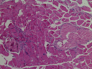 Muscle biopsy which shows endomysial lymphocytary infiltrate and myocyte necrosis.