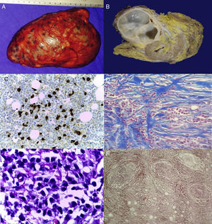 (A) Macroscopic tumour. (B) Surgical specimen, solid well defined tumour, fibrous in appearance, which does not invade the renal parenchyma. (C) Microphotography (40×). Reaction of the indirect immunoperoxidase with anti-IgG4 antibody, with over 40 plasmatic cells. (D) Microphotography (40×) with Mason staining. Fibrosis with focally steriform pattern. (E) Microphotography (100×). Inflammatory infiltrate predominantly composed of plasmatic cells. (F) Microphotography (10×) obliterating phlebitis consistent with extensive fibrosis and lymphoplasmacytic infiltrate.