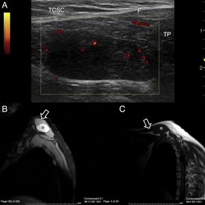 (A) Trapezius (TP) ultrasound scan, longitudinal slice on cephalic edge. A hypoechoic mass is observed, homogenous in appearance and completed contained within the thickness of the muscle with no contact with the fascia (F) or subcutaneous cellular tissue (SCCT). The power Doppler signal is essentially concentrated in peripheral regions. (B) NMR of the shoulder, DP/SPIR sequence to remove fatty tissue. Transversal slice of the trapezius (arrow). In its interior a hyperintense structure with well defined edges is enhanced and this occupies almost all of the muscle matter (*). (C) NMR of the shoulder, T1 sequence, sagittal slice. In this projection the longitudinal extension of the trapezius (arrow) is appreciated and the occupation by the same fusiform, hypointense structure, with respect to the adjacent tissues. (*).