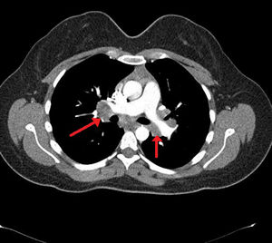 Torax CT of the patient showed bilateral hilar lymphadenopaties.