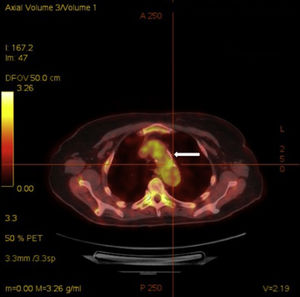 Axial 18FDG PET/CT view showing an increased uptake of 18F-fluorodeoxyglucose at the thoracic aorta (arrow).