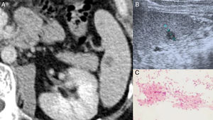 (A) Contrast-enhanced CT scan of the abdomen reveals a hypodense splenic nodule near the splenic hilum. (B) Abdominal ultrasound of the spleen depicts the same lesion as a hypoechoic nodule without posterior acoustic enhancement. (C) Cytology from lymphadenopathy