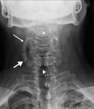 Proximal cervical rib (thin arrow) originating in vertebral body C3 (star) in a caudal direction and articulating with another distal supernumerary rib (thick arrow) originating and ascending from vertebral body C7 (arrow tip).