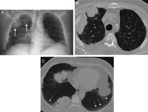 (A) Posteroanterior X-ray of the chest in which several nodular opacities are observed in the right lung (arrow). Note the presence of a subtle bibasal enlargement of the lung interstitium. (B) Axial image of chest CT which confirms the presence of right lung masses (asterisks). (C) Axial image of chest CT (minimum intensity projection) in which a bibasal lung interstitium reticulation (arrows) may be observed in relation to the patient