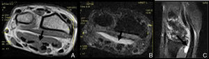 (A) Axial T1; (B) Axial STIR; (C) Sagittal STIR. Arrows: T1 hypointense material with increased signal in STIR, within the sheath of the carpal flexor tendon level.