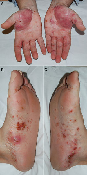 Appearance of pustular lesions, mainly located on the thenar eminences of both palms (A) and on the medial zone of the soles of the right (B) and left (C) feet, showing a tendency to converge and leaving wide zones of flaking and erythema on the hands.