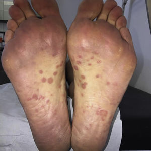 Salmon-colored lesions on the soles of both feet.