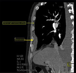 CT image of the thorax, sagittal view. The internal mammary artery and the haematoma that originates from its rupture can be observed.