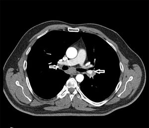 Thorax CT showed bilateral hilar lymphadenopathy.