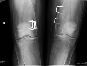 Distinctive image of the knees, with surgical material from surgery during childhood for genu valgum and the characteristic morphology in “Erlenmeyer flask” of the distal femur.