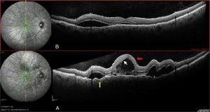 Right eye: (A) On diagnosis. (B) Seven days after diagnosis. Serous detachment>450 (grey arrow) septated (asterisk). Hyperreflective points (white arrow). Retinal pigment epithelial folds (tip of the black arrow).